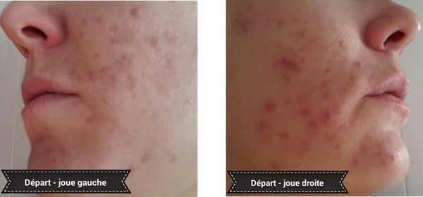 Mon traitement curacné / roaccutane - Page 2