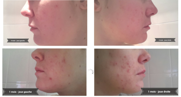 Mon traitement curacné / roaccutane